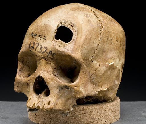 Physical Anthropology. Image of a partial human skull with a large hole in the forehead from trauma.